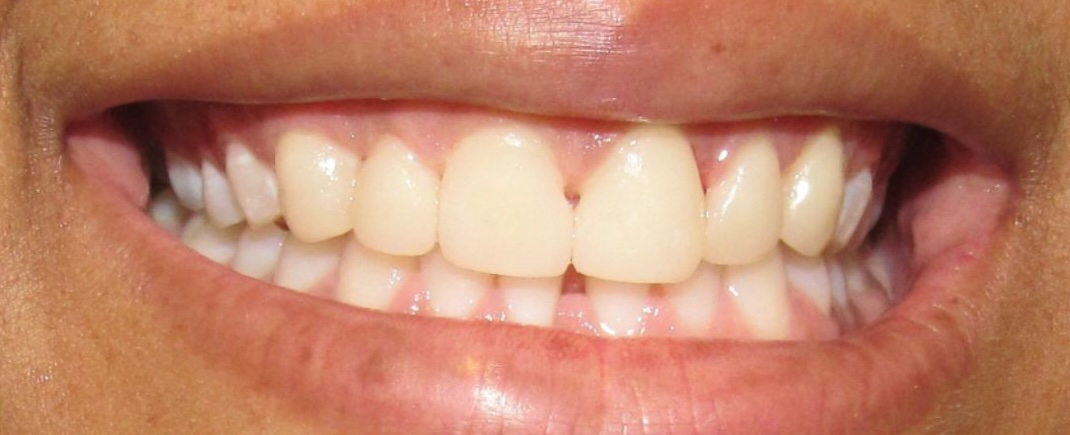 Teeth whitening before