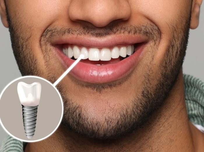 Ceramic Dental Implants: The Metal-Free Way to Restore Your Smile