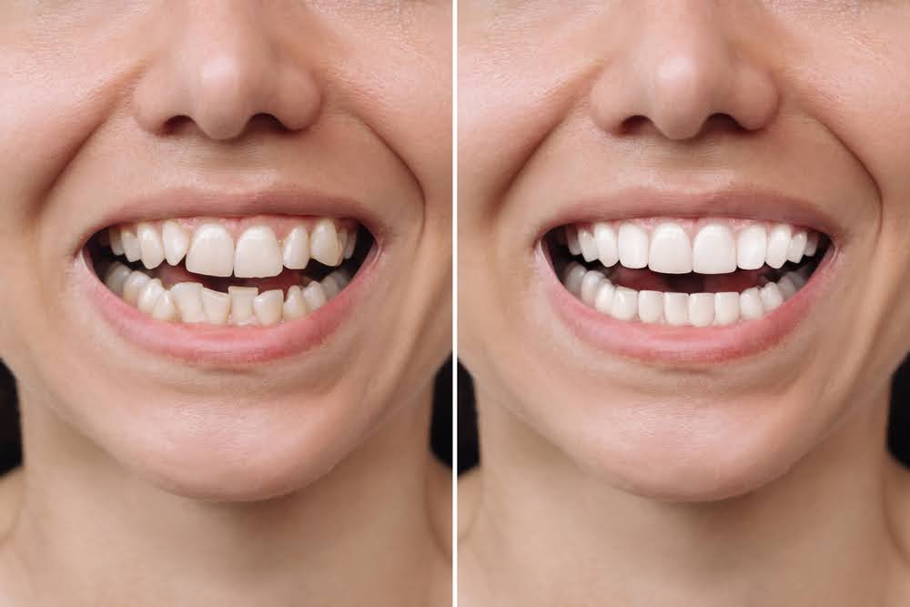 Before and after treatment from Dr. Terry Victor, your trusted Washington, DC, cosmetic dentist.